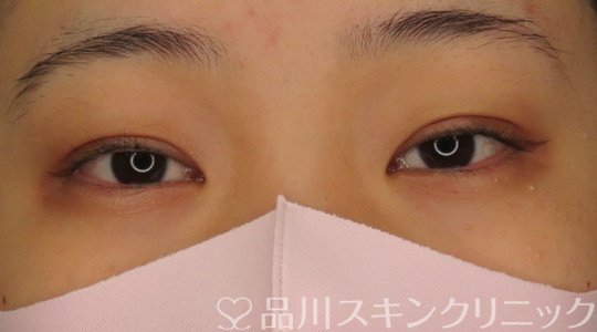 症例NO.71090のAFTER写真