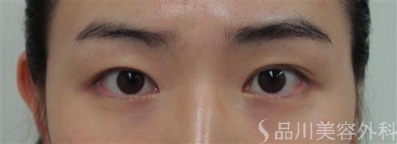 症例NO.30998のBEFORE写真