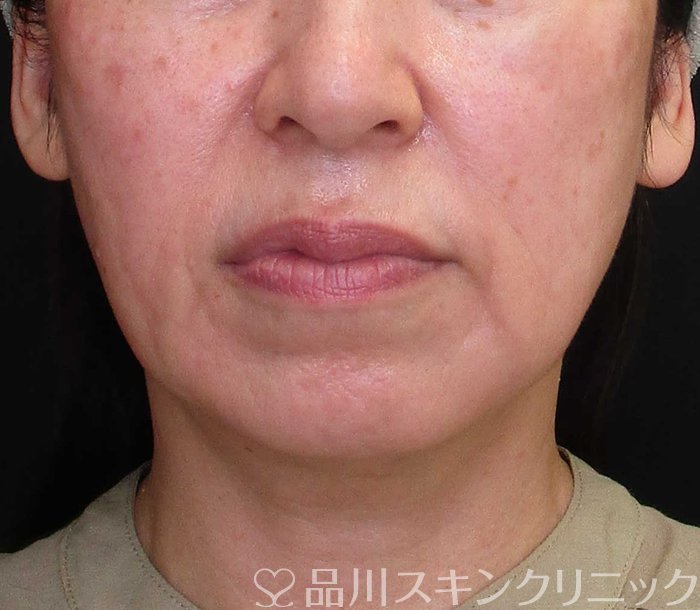 症例NO.68007のBEFORE写真