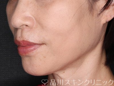 症例NO.74464のAFTER写真