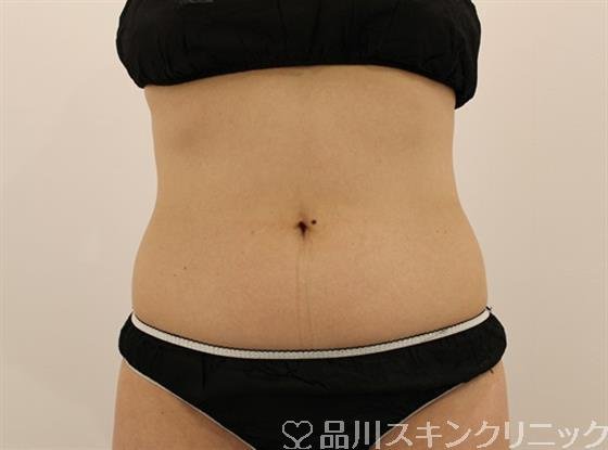 症例NO.49451のBEFORE写真