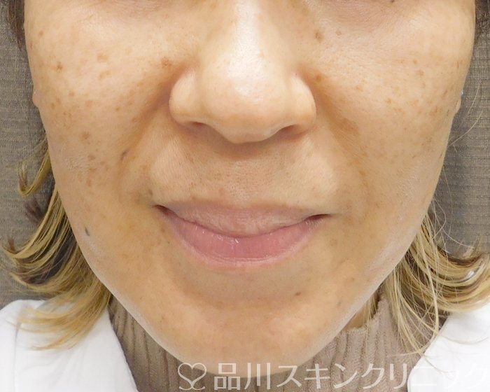 症例NO.65643のBEFORE写真