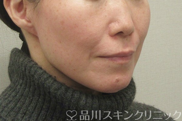 症例NO.75393のBEFORE写真
