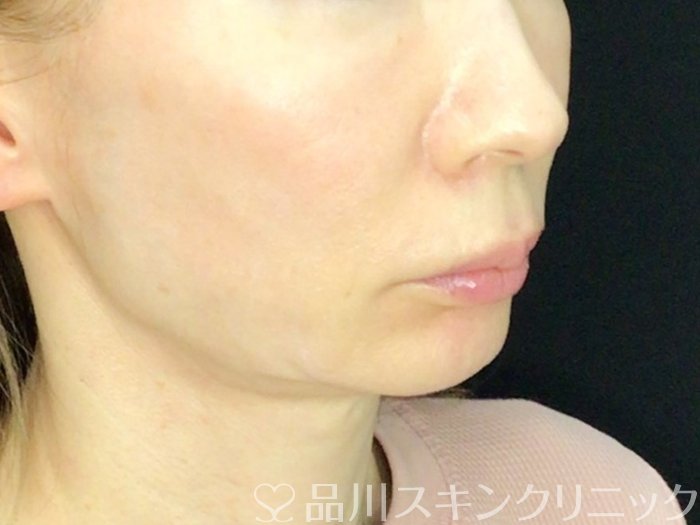 症例NO.72616のBEFORE写真