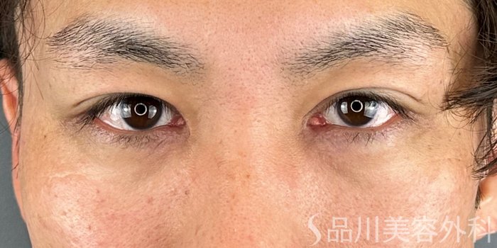 症例NO.70737のBEFORE写真