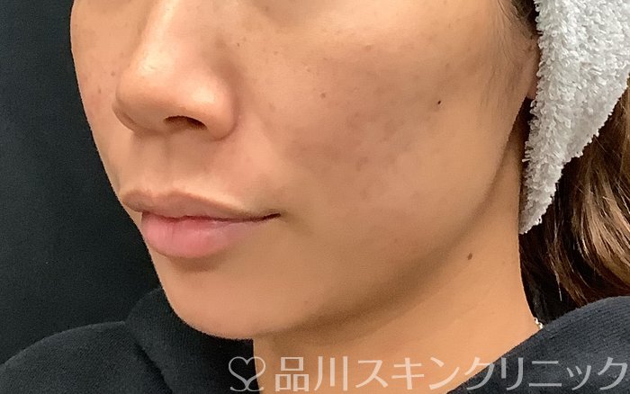 症例NO.67961のBEFORE写真
