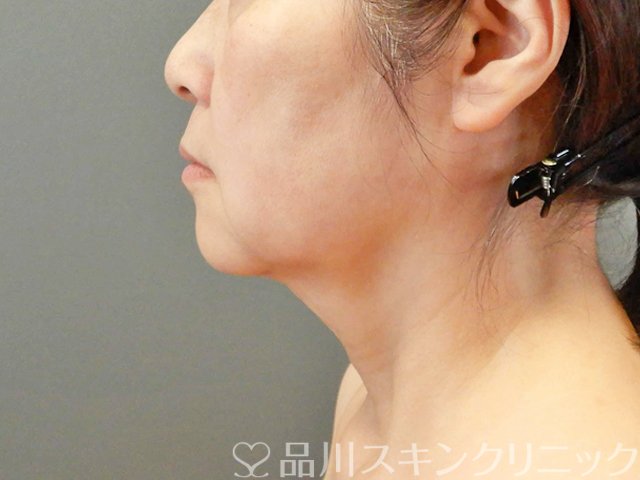 症例NO.67754のBEFORE写真
