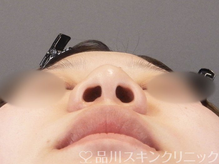 症例NO.63645のBEFORE写真