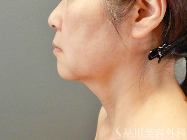 症例NO.67754のBEFORE写真