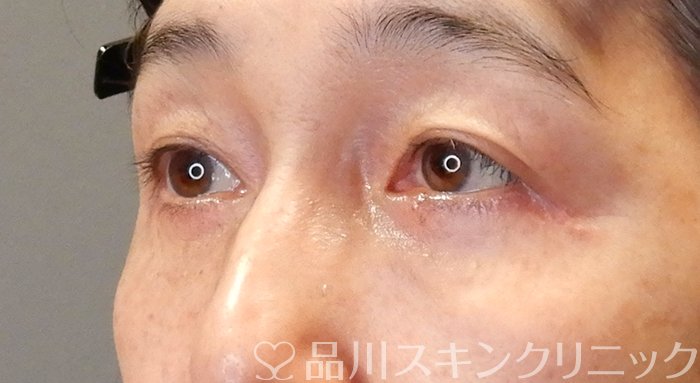 症例NO.64331のAFTER写真