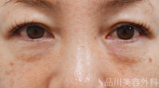 症例NO.74141のBEFORE写真