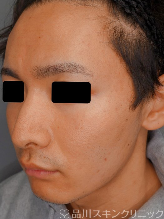 症例NO.73585のAFTER写真