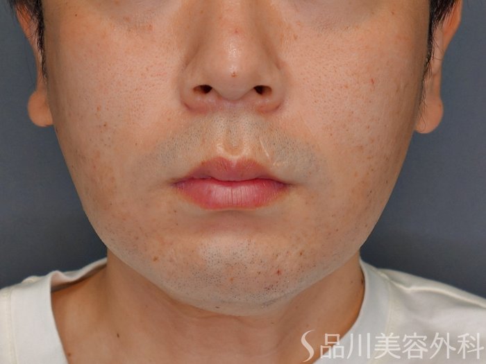 症例NO.73543のBEFORE写真