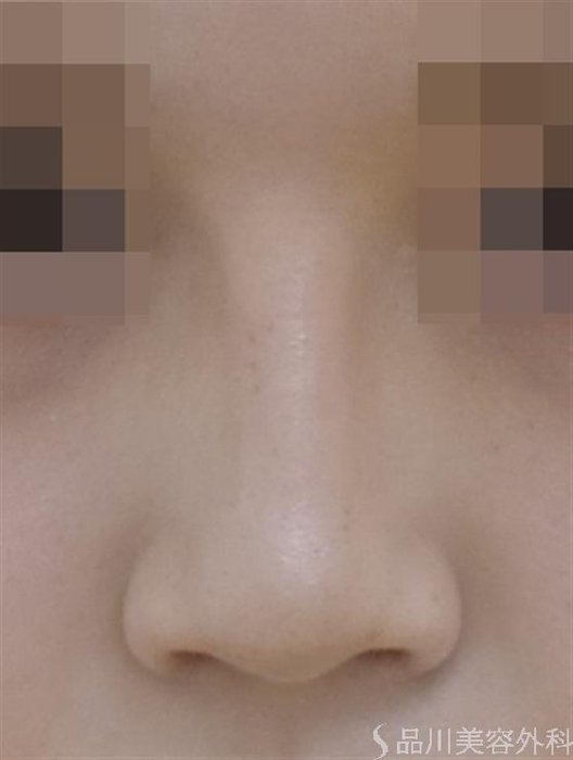 症例NO.47631のAFTER写真