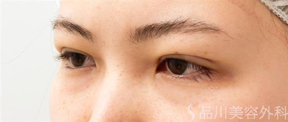症例NO.55242のAFTER写真