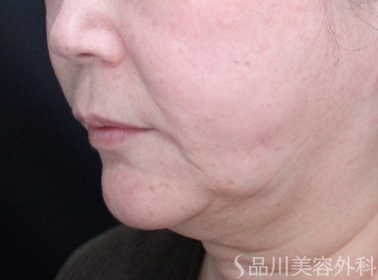 症例NO.74903のBEFORE写真
