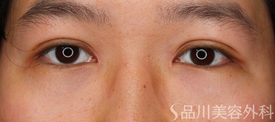 症例NO.64949のAFTER写真