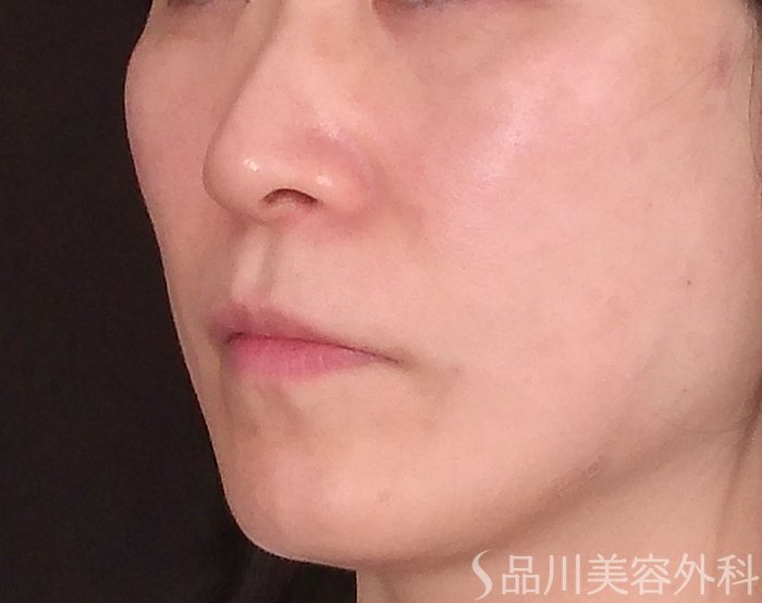 症例NO.70153のAFTER写真