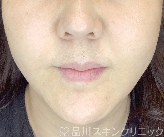 症例NO.65848のAFTER写真