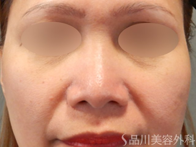 症例NO.71796のBEFORE写真