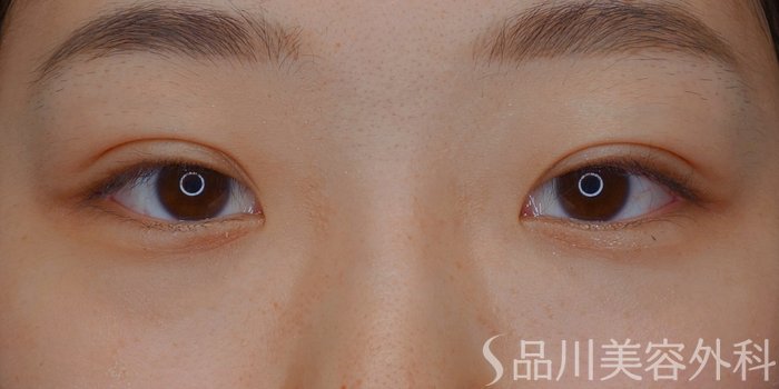 症例NO.74315のAFTER写真
