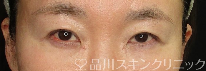 症例NO.70494のAFTER写真