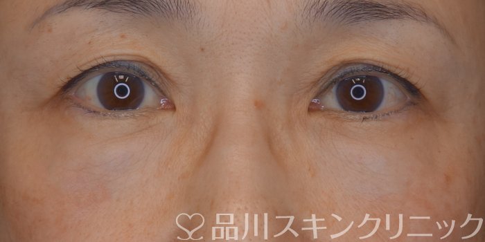 症例NO.74249のAFTER写真