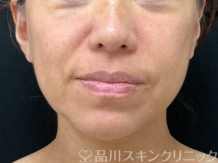 症例NO.74336のBEFORE写真