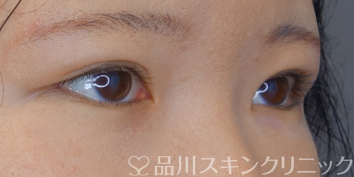 症例NO.71543のAFTER写真
