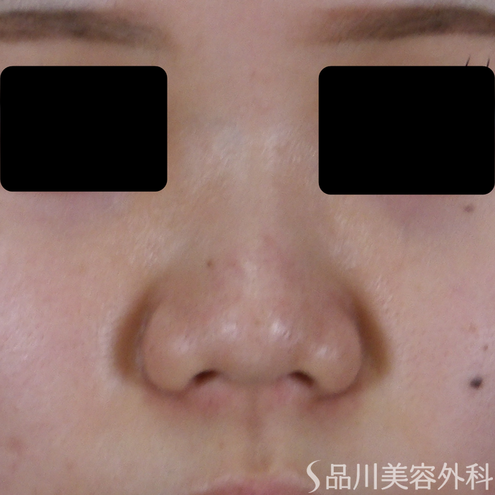 症例NO.71133のBEFORE写真
