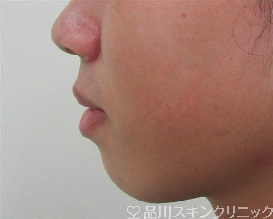 症例NO.30735のBEFORE写真