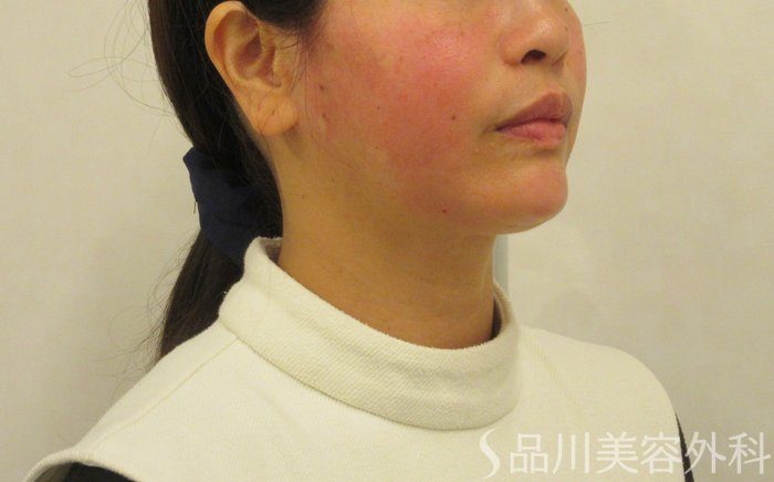 症例NO.72375のAFTER写真