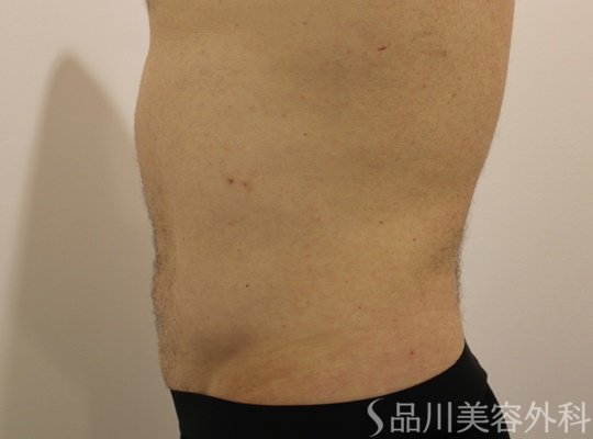 症例NO.74087のAFTER写真