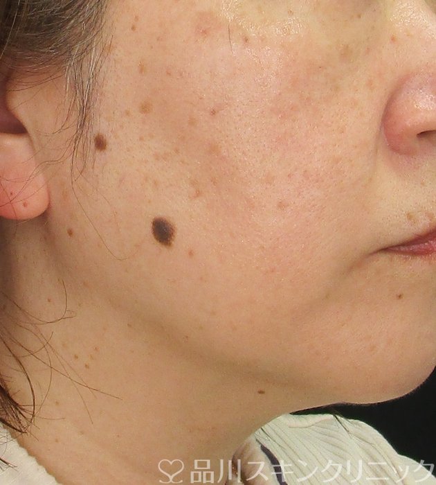 症例NO.73187のAFTER写真