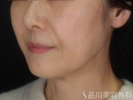 症例NO.73524のBEFORE写真