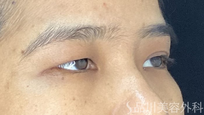 症例NO.72198のBEFORE写真