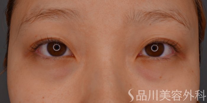 症例NO.74411のBEFORE写真