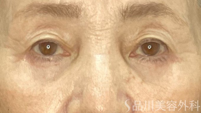 症例NO.72224のAFTER写真