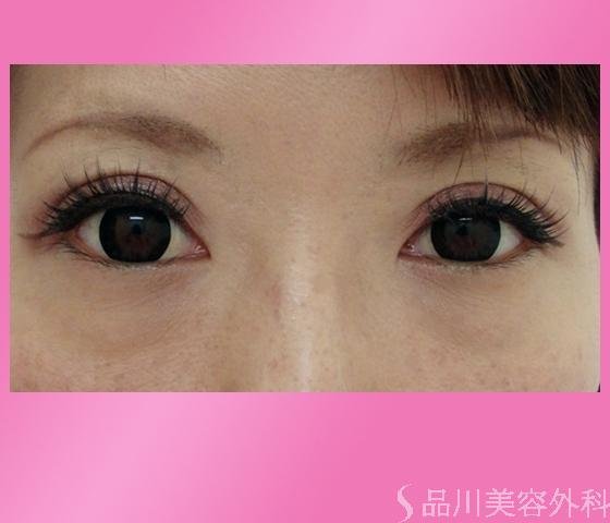 症例NO.1175のAFTER写真