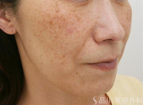 症例NO.31581のBEFORE写真