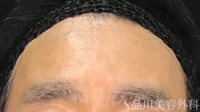 症例NO.70538のBEFORE写真