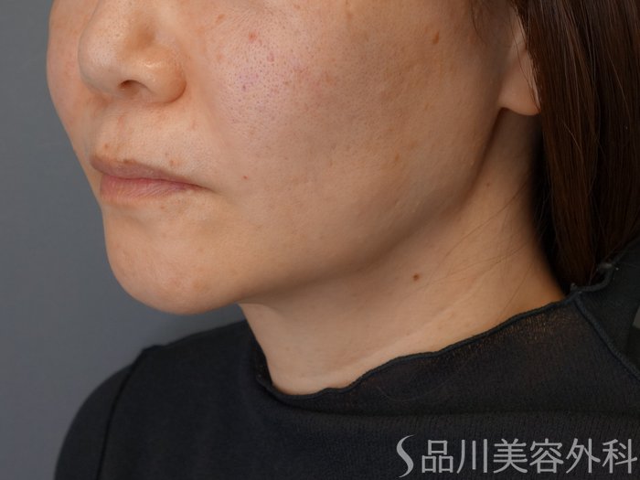 症例NO.72966のAFTER写真