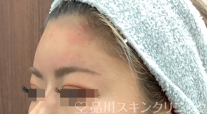症例NO.69483のAFTER写真