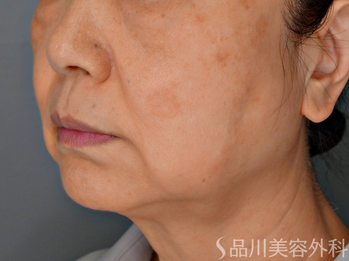 症例NO.73188のBEFORE写真