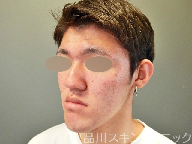 症例NO.69061のBEFORE写真