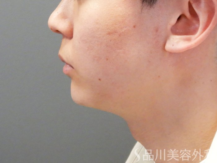 症例NO.70193のAFTER写真
