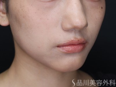 症例NO.71914のAFTER写真