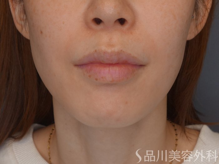 症例NO.72390のBEFORE写真