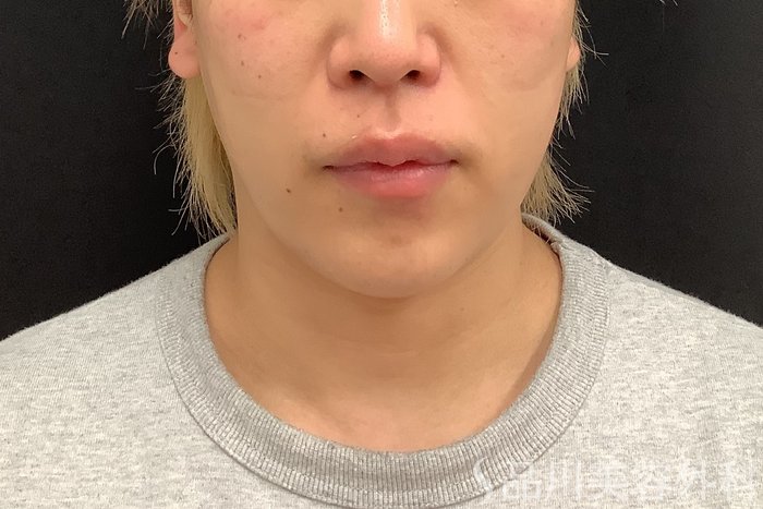 症例NO.75333のBEFORE写真
