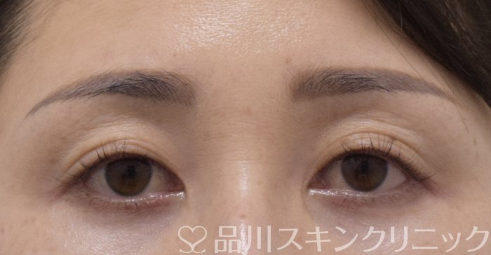 症例NO.75017のBEFORE写真